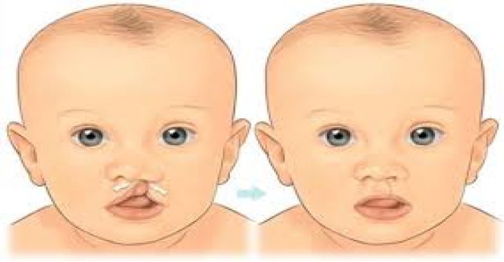 Dị tật bẩm sinh khe hở môi - khe hở vòm miệng 5 khe ho moi vom