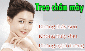 treo chan may