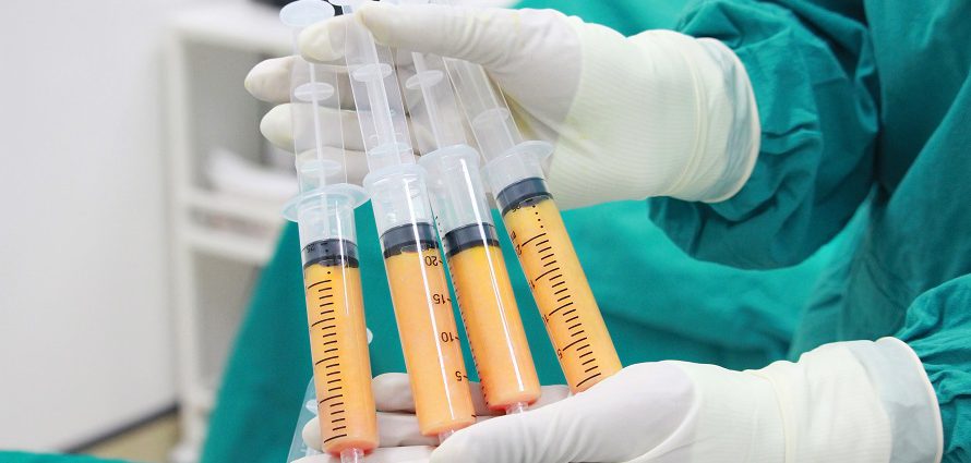 Làm đầy bắp chân bằng túi gel hay mỡ tự thân 4 mo tu than