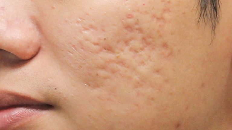 Điều trị sẹo lõm bằng cấy mỡ tự thân 3 seo lom