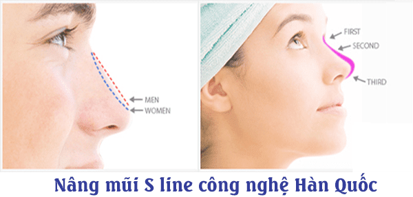 Nâng mũi S-Line 5 nang mui s-line
