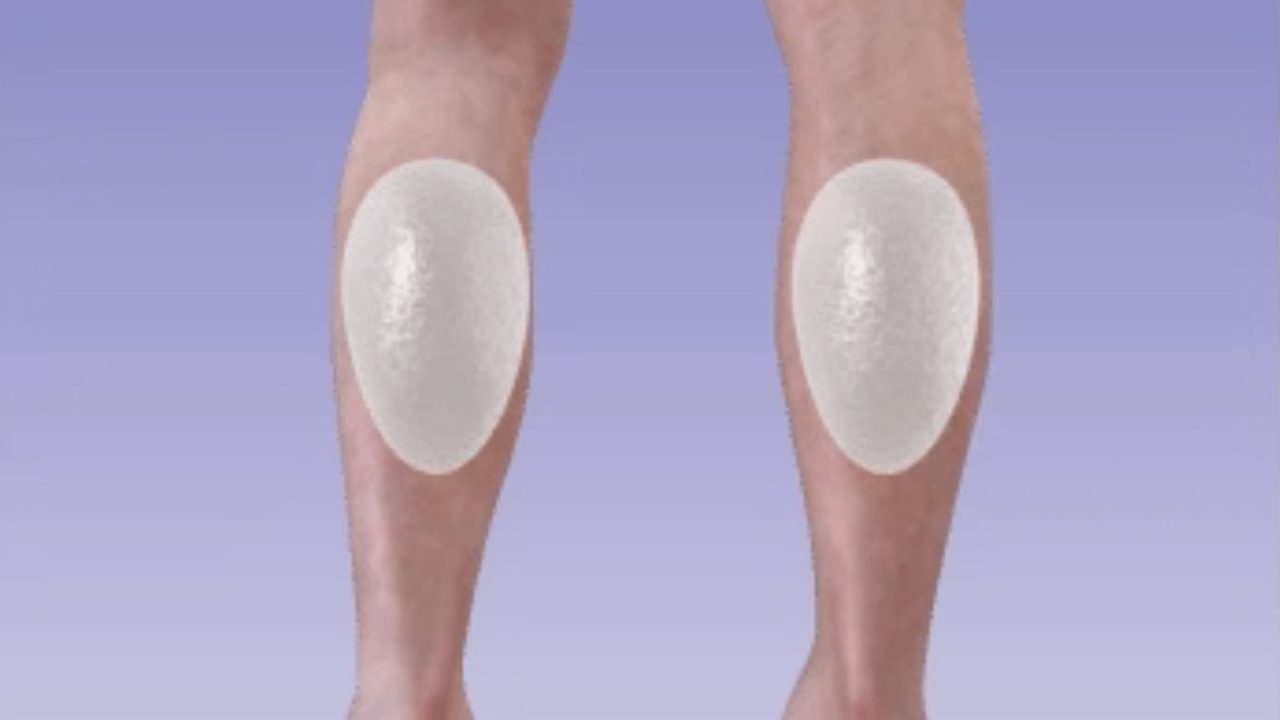 Làm đầy bắp chân bằng túi gel hay mỡ tự thân 1 day bap chan