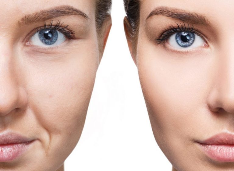 Chuyển mô mỡ làm đầy rãnh mũi-mắt 5 chuyen mo mo