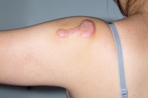 Điều trị sẹo lồi 3 seo loi