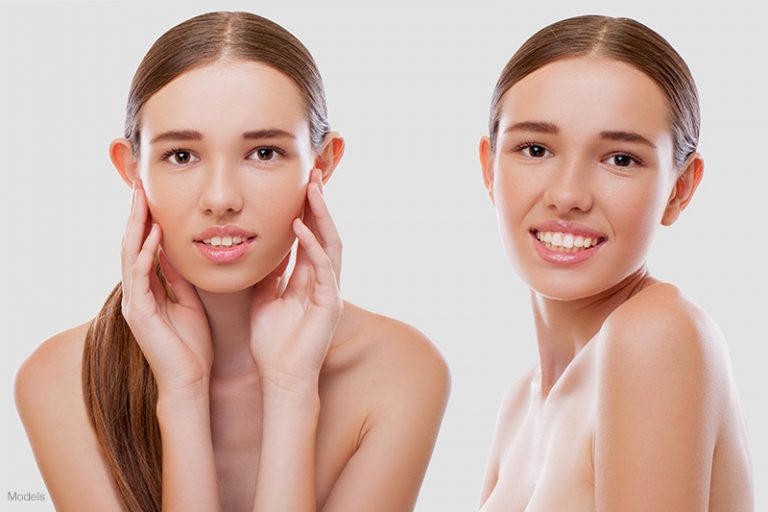 Phẫu thuật điều trị tai vểnh tai thỏ 2 tai venh