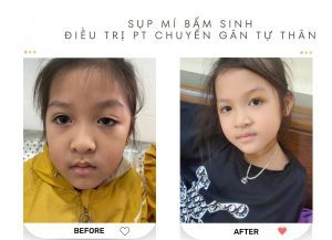 Sụp mí mắt bẩm sinh