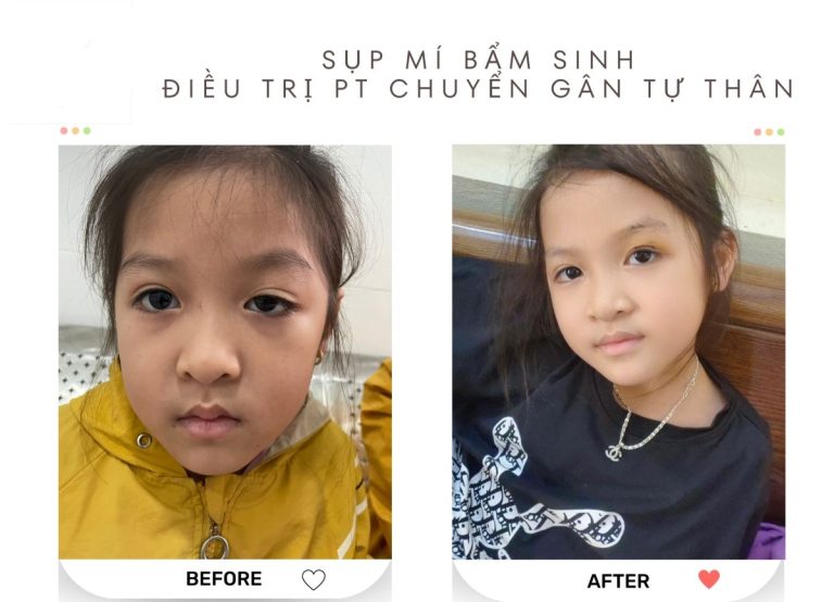 Sụp mí mắt bẩm sinh