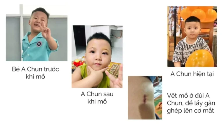 Hành trình tìm lại ánh nhìn đẹp đẽ của A Chun 7 Hành trình tìm lại đôi mặt đẹp cho bé A Chun
