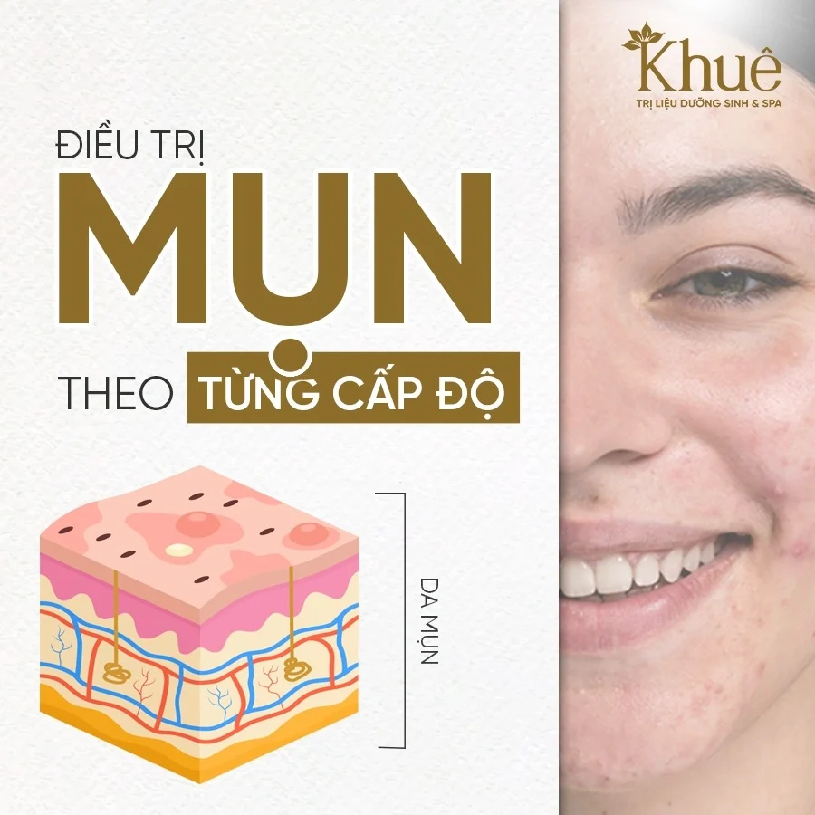 Điều trị mụn theo cấp độ