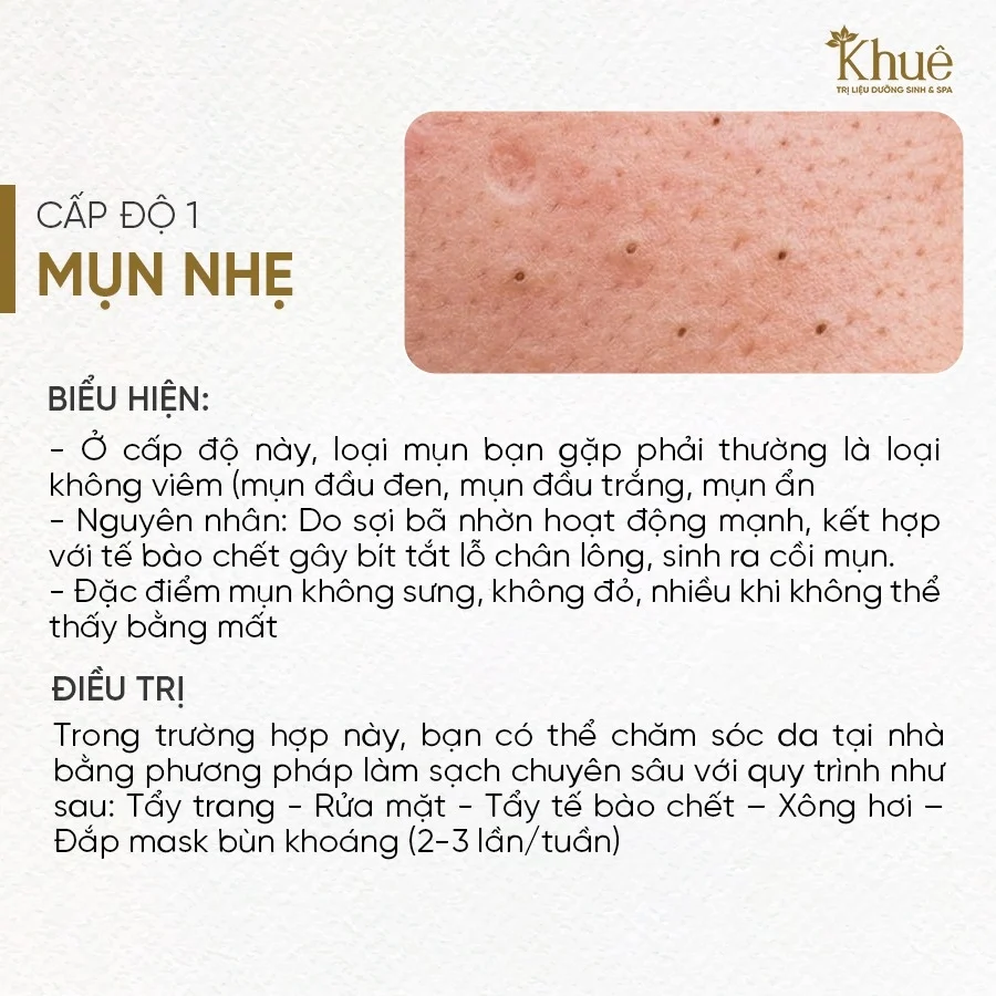 Mụn cấp độ 1