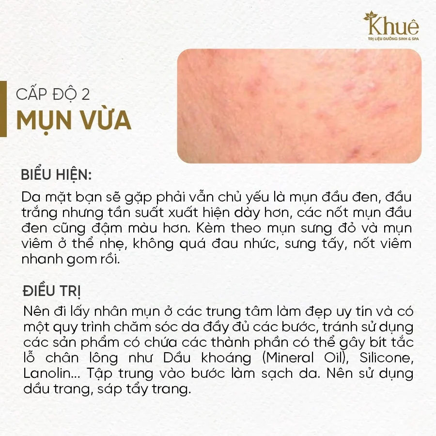 Mụn cấp độ 2