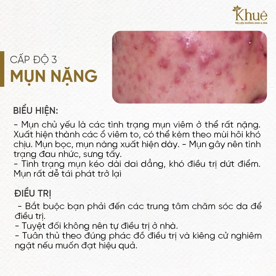 Mụn cấp độ 3