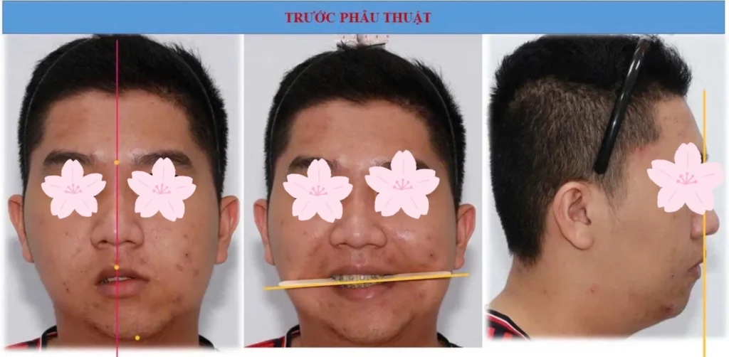 Bệnh viện Răng Hàm Mặt Huế triển khai thành công ứng dụng công nghệ 3D 2 Bệnh nhân trước ca mổ