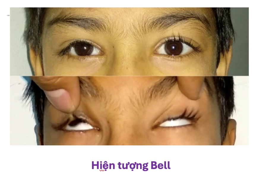 Sụp Mí Bẩm Sinh Ở Trẻ Và Phương pháp Điều Trị 3 Hien tuong Bell