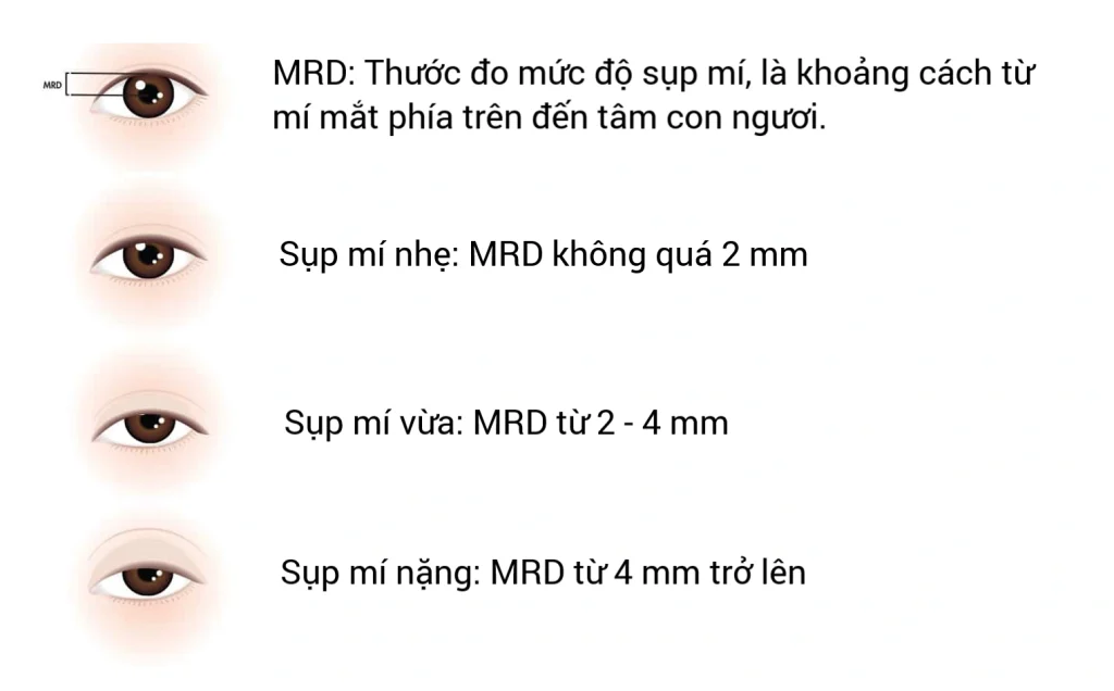 Sụp Mí Bẩm Sinh Ở Trẻ Và Phương pháp Điều Trị 2 Các mức độ sụp mí