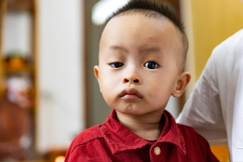 Sụp mí mắt là gì? Câu chuyện về Bé Hà Nhi suýt bị mất thị lực 3 Một bé bị sụp mí bẩm sinh